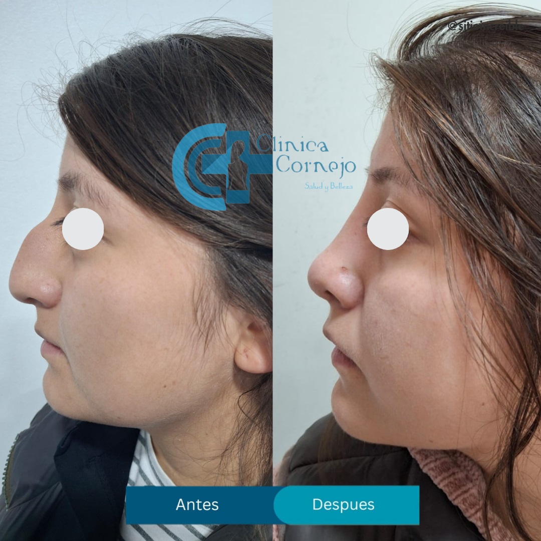 Rinoplastia resultado
